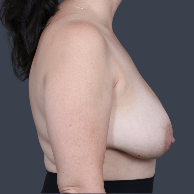 Breast Reduction Before & After Gallery - Patient 134433 - Image 5