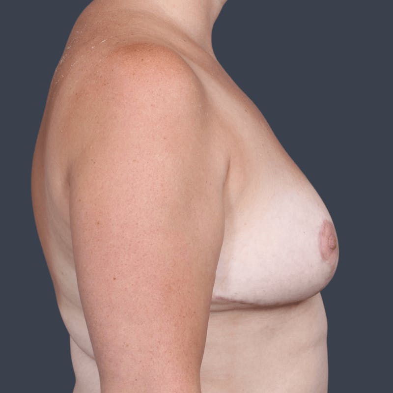 Breast Reduction Before & After Gallery - Patient 134433 - Image 6