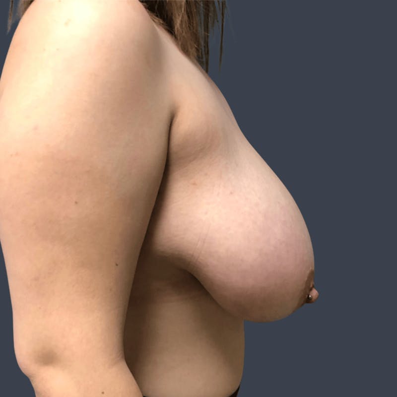 Breast Reduction Before & After Gallery - Patient 270083 - Image 3