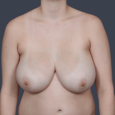 Breast Lift Before & After Gallery - Patient 369634 - Image 1