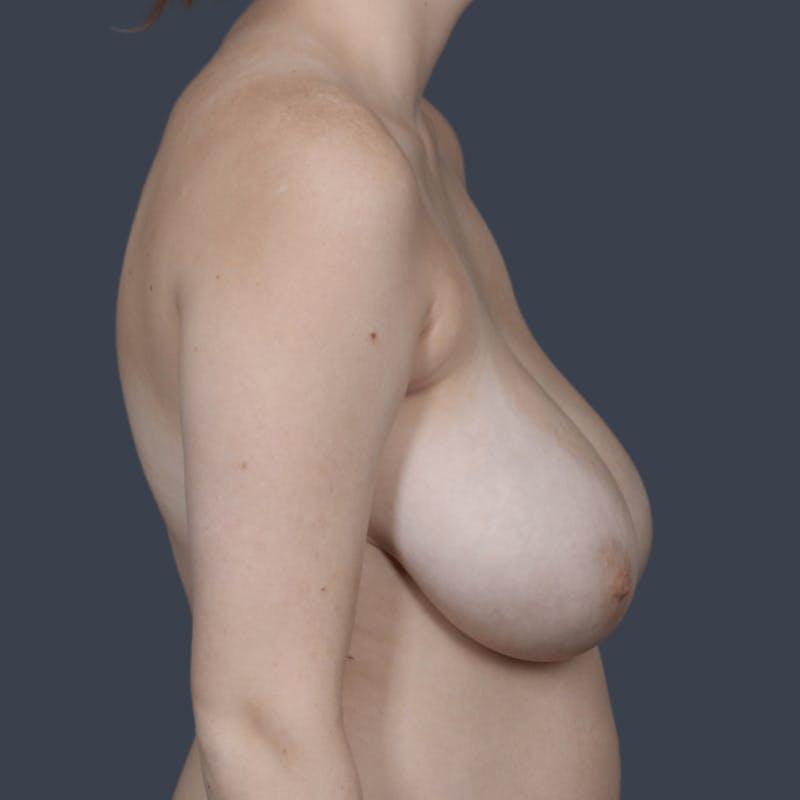 Breast Lift Before & After Gallery - Patient 369634 - Image 5