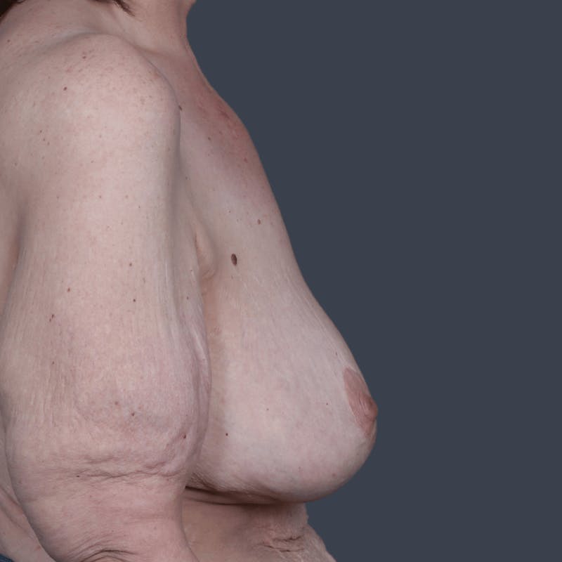 Breast Reconstruction Revision Before & After Gallery - Patient 331463 - Image 5
