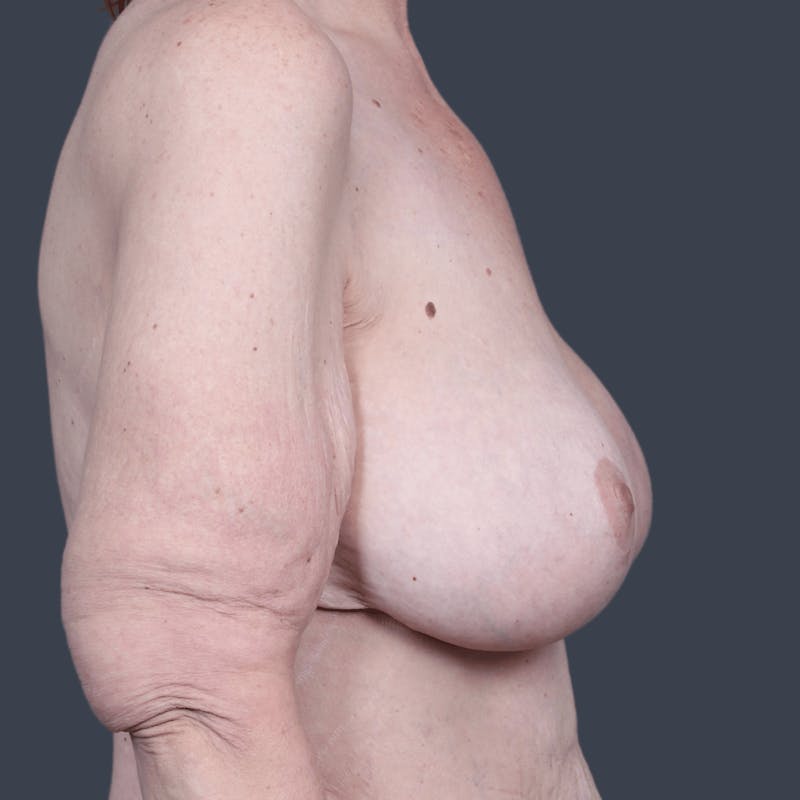 Breast Reconstruction Revision Before & After Gallery - Patient 331463 - Image 6