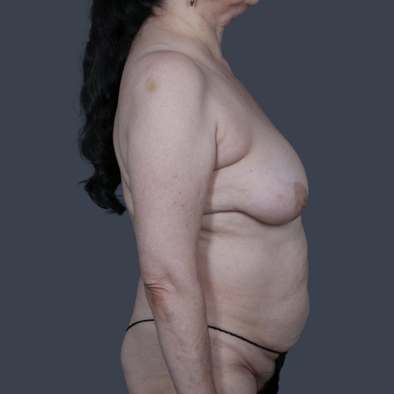 DIEP Flap Before & After Gallery - Patient 111446 - Image 5