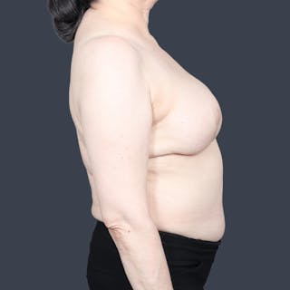 DIEP Flap Before & After Gallery - Patient 111446 - Image 6