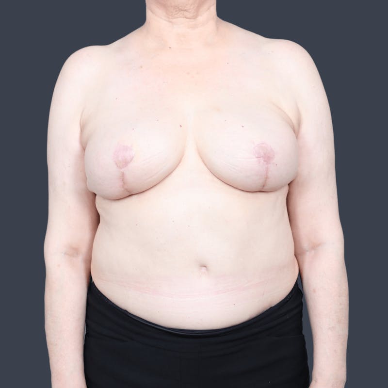 DIEP Flap Before & After Gallery - Patient 111446 - Image 2