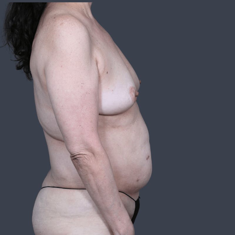 DIEP Flap Before & After Gallery - Patient 313351 - Image 5