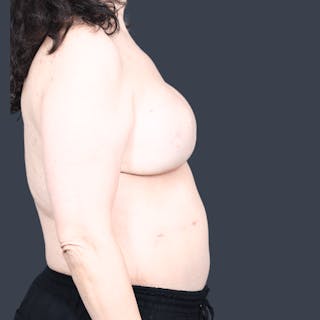 DIEP Flap Before & After Gallery - Patient 313351 - Image 6