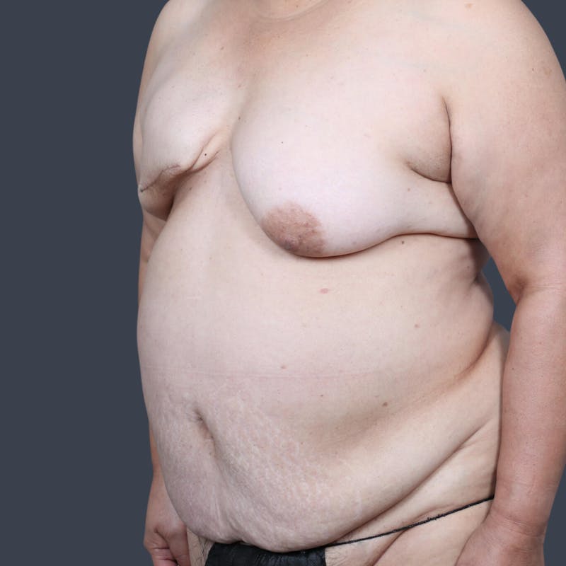 DIEP Flap Before & After Gallery - Patient 194039 - Image 3