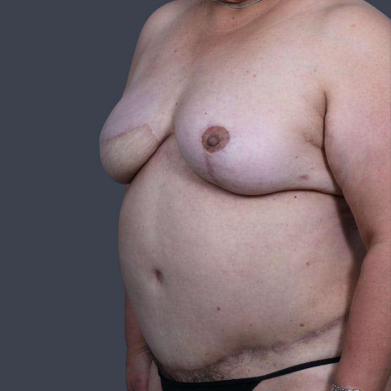 DIEP Flap Before & After Gallery - Patient 194039 - Image 4
