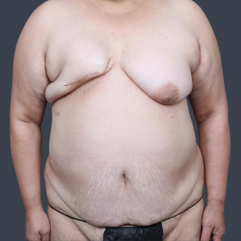 DIEP Flap Before & After Gallery - Patient 194039 - Image 1