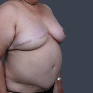 DIEP Flap Before & After Gallery - Patient 194039 - Image 6