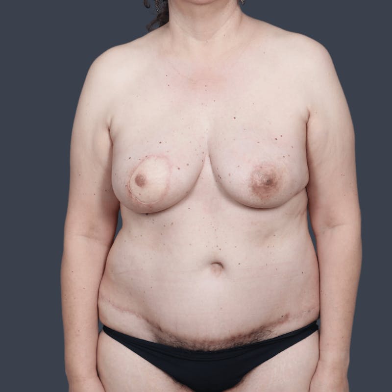 DIEP Flap Before & After Gallery - Patient 368723 - Image 2