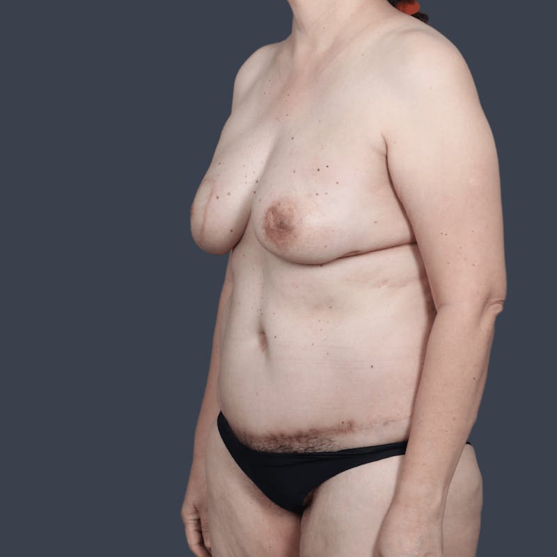 DIEP Flap Before & After Gallery - Patient 368723 - Image 6