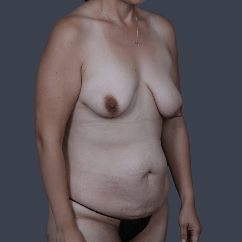 DIEP Flap Before & After Gallery - Patient 272271 - Image 3