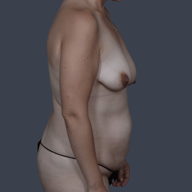 DIEP Flap Before & After Gallery - Patient 272271 - Image 5