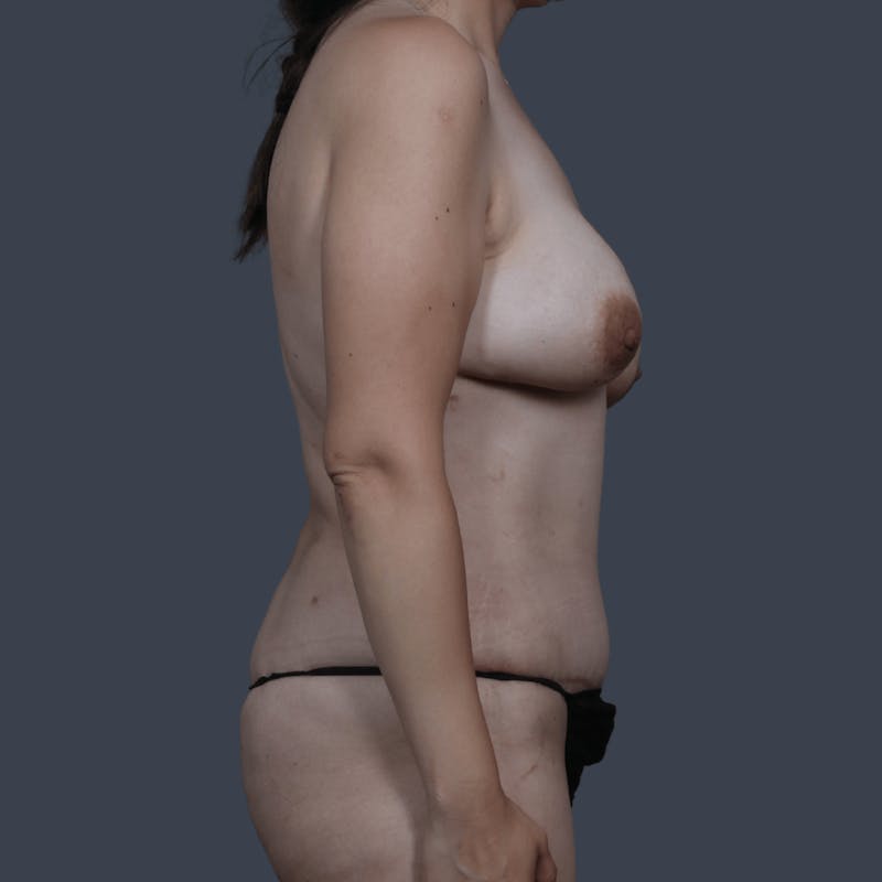 DIEP Flap Before & After Gallery - Patient 272271 - Image 6