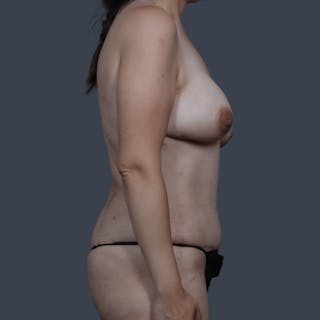 DIEP Flap Before & After Gallery - Patient 272271 - Image 6