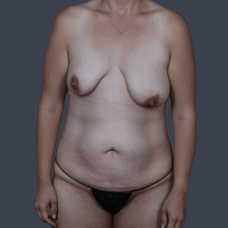 DIEP Flap Before & After Gallery - Patient 272271 - Image 1