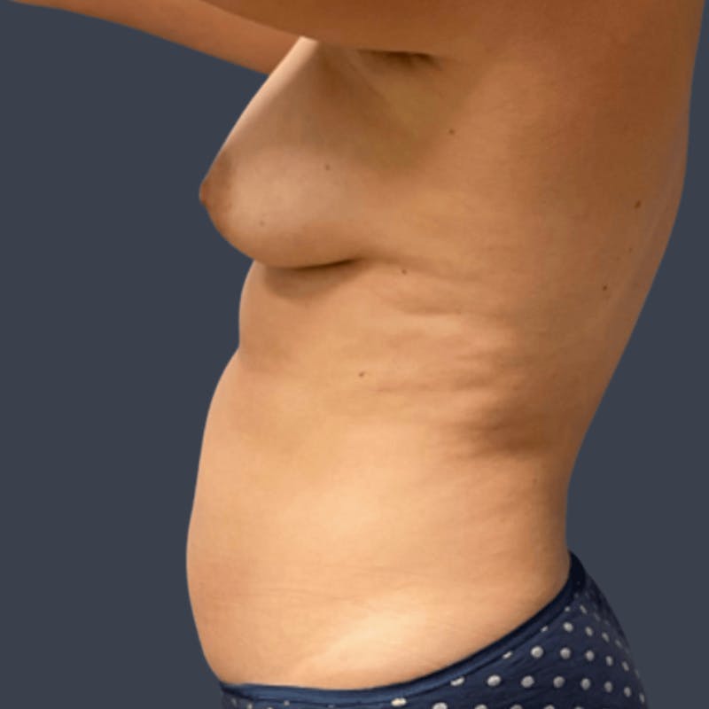 Abdominoplasty / Tummy Tuck Before & After Gallery - Patient 132881 - Image 3