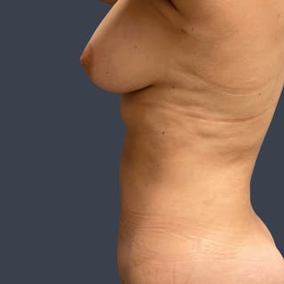 Abdominoplasty / Tummy Tuck Before & After Gallery - Patient 132881 - Image 4