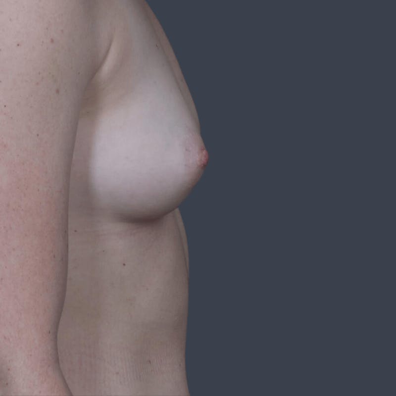 Breast Augmentation Before & After Gallery - Patient 271492 - Image 6