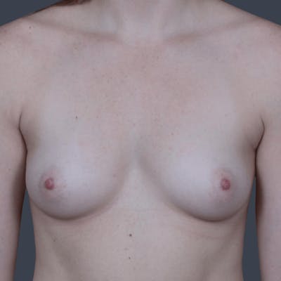 Breast Augmentation Before & After Gallery - Patient 271492 - Image 1