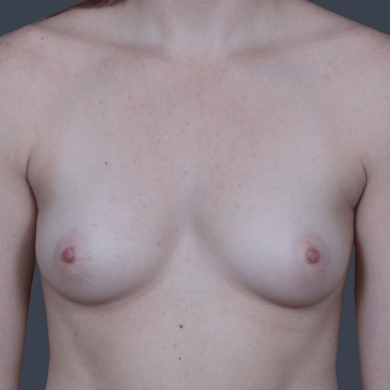 Breast Augmentation Before & After Gallery - Patient 271492 - Image 1