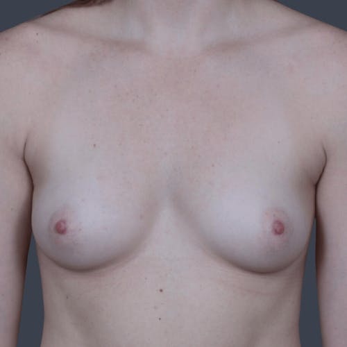 Before procedure image for Breast Augmentation