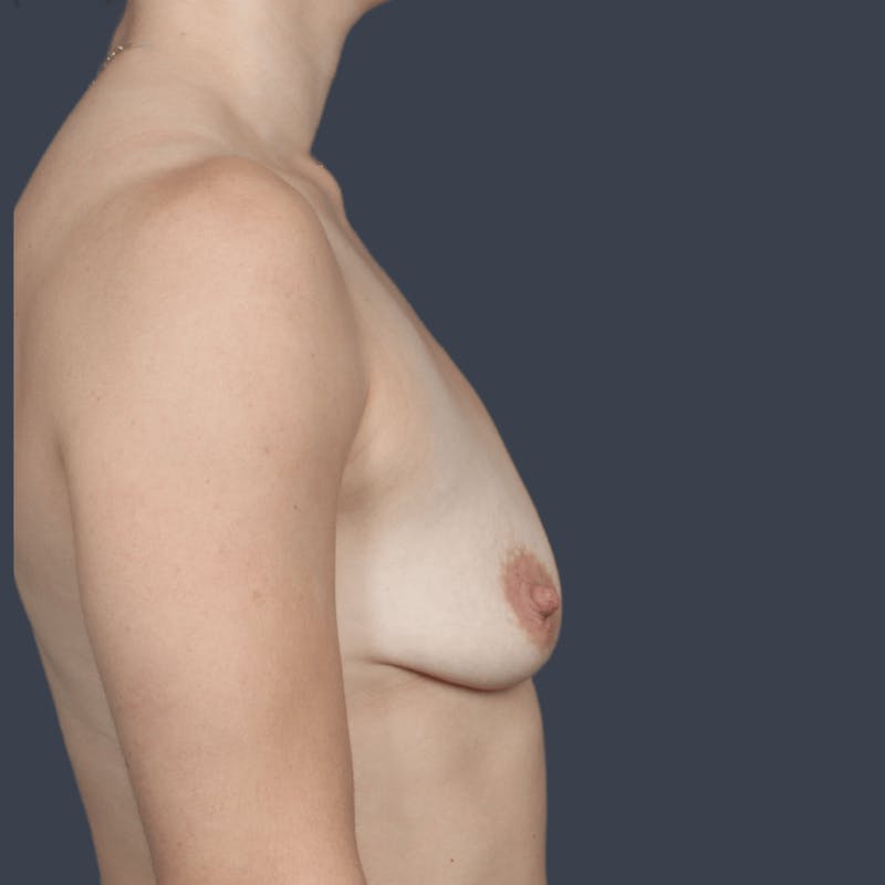 Breast Augmentation Before & After Gallery - Patient 879681 - Image 5