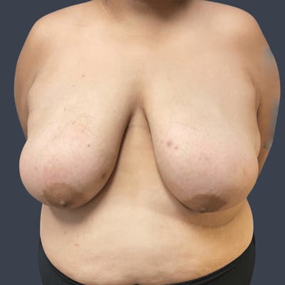 Top Surgery Before & After Gallery - Patient 175503 - Image 1