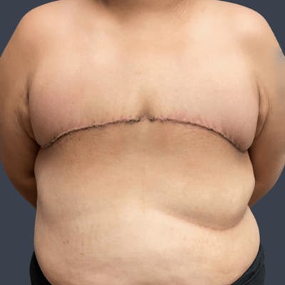 Top Surgery Before & After Gallery - Patient 175503 - Image 2