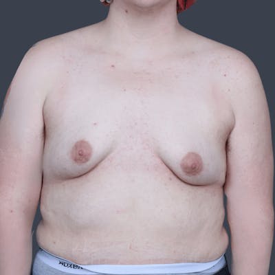 Top Surgery Before & After Gallery - Patient 205642 - Image 1
