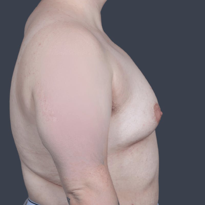 Top Surgery Before & After Gallery - Patient 205642 - Image 3