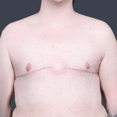 Top Surgery Before & After Gallery - Patient 205642 - Image 2