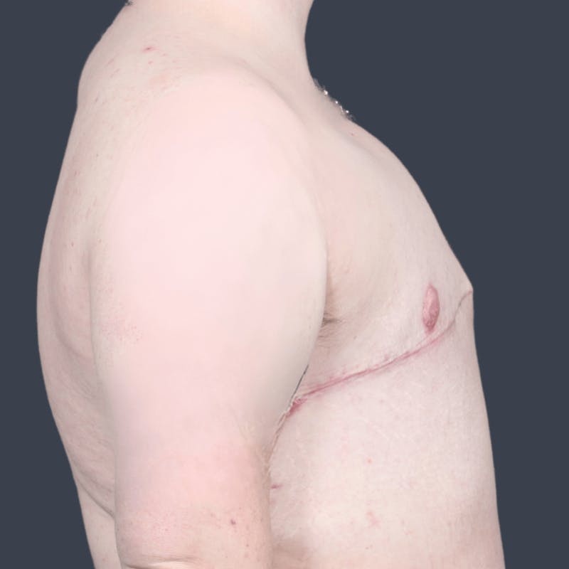 Top Surgery Before & After Gallery - Patient 205642 - Image 4