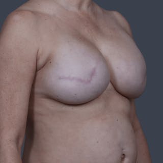 Breast Reconstruction Revision Before & After Gallery - Patient 298219 - Image 4