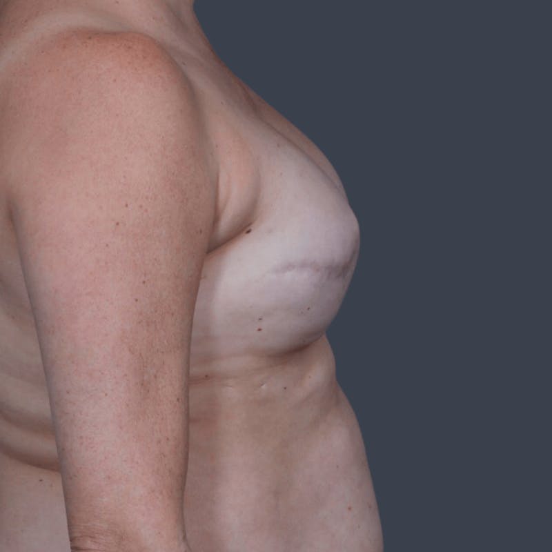 Breast Reconstruction Revision Before & After Gallery - Patient 298219 - Image 5