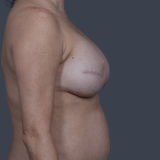 Breast Reconstruction Revision Before & After Gallery - Patient 298219 - Image 6