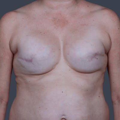 Breast Reconstruction Revision Before & After Gallery - Patient 298219 - Image 1