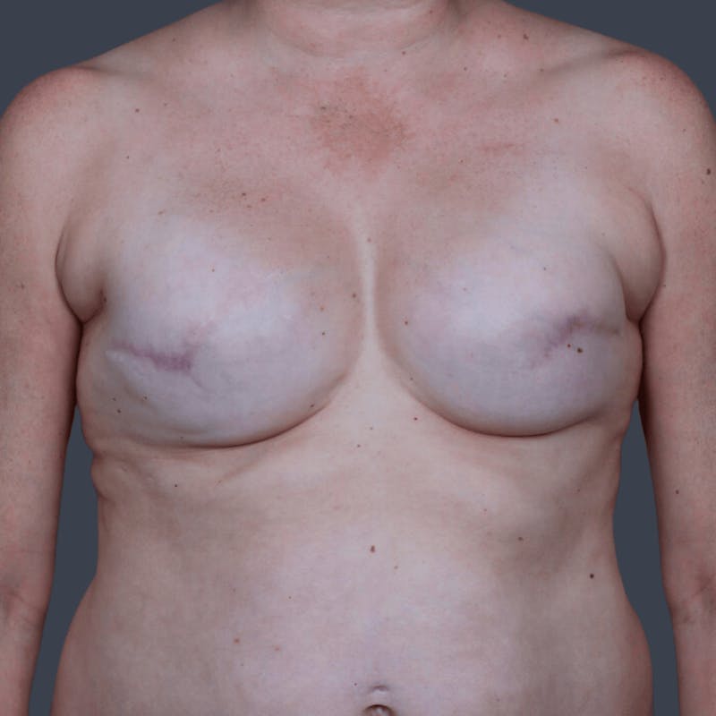 Breast Reconstruction Revision Before & After Gallery - Patient 298219 - Image 1