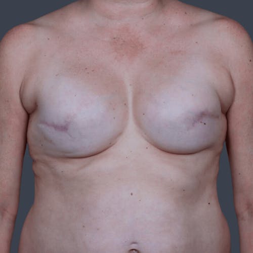 Before procedure image for Breast Reconstruction Revision