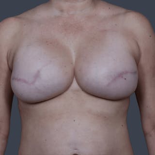 Breast Reconstruction Revision Before & After Gallery - Patient 298219 - Image 2