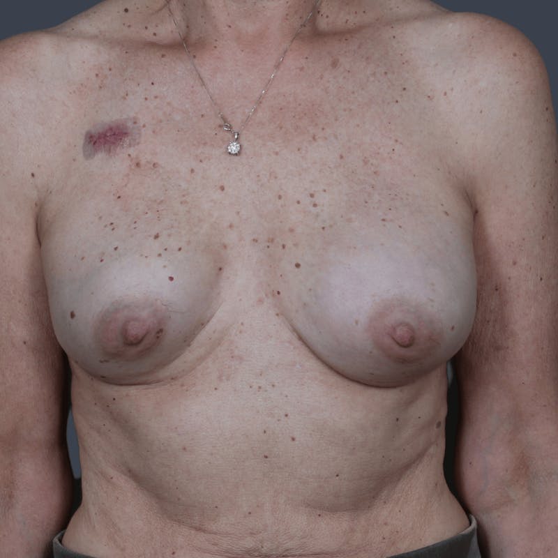 Breast Reconstruction Revision Before & After Gallery - Patient 312480 - Image 1