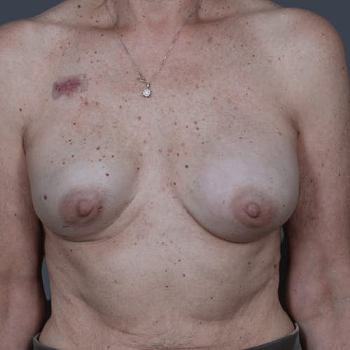Before procedure image for Breast Reconstruction Revision
