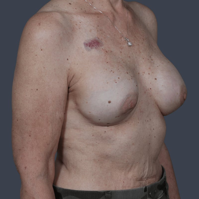Breast Reconstruction Revision Before & After Gallery - Patient 312480 - Image 3