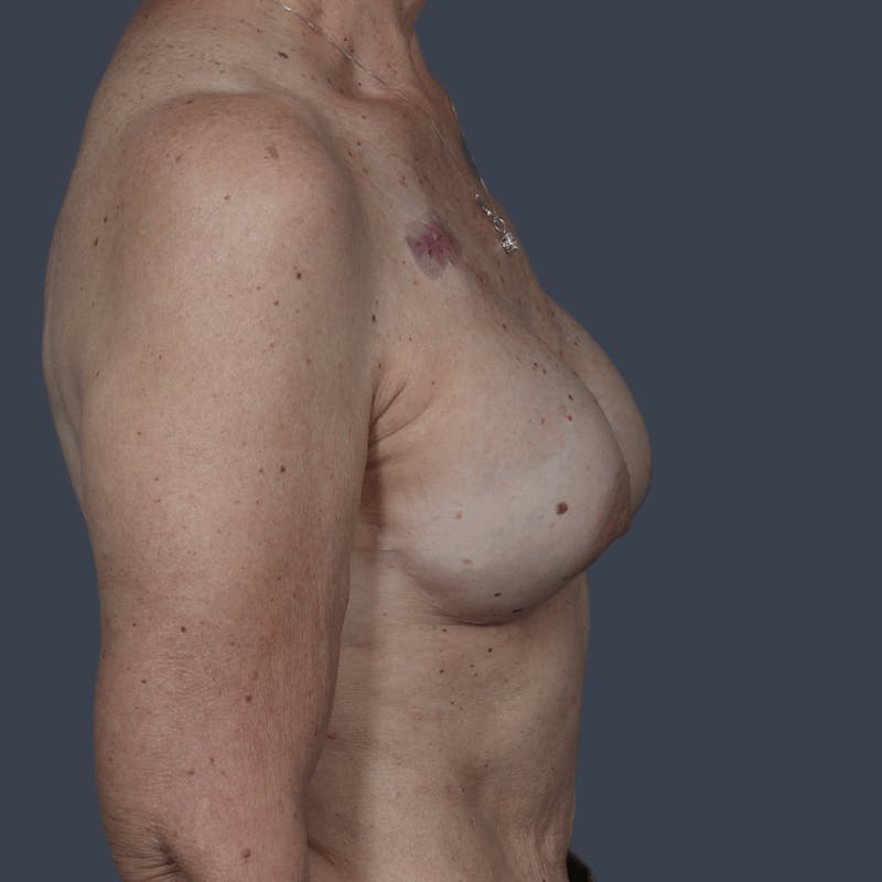 Breast Reconstruction Revision Before & After Gallery - Patient 312480 - Image 5