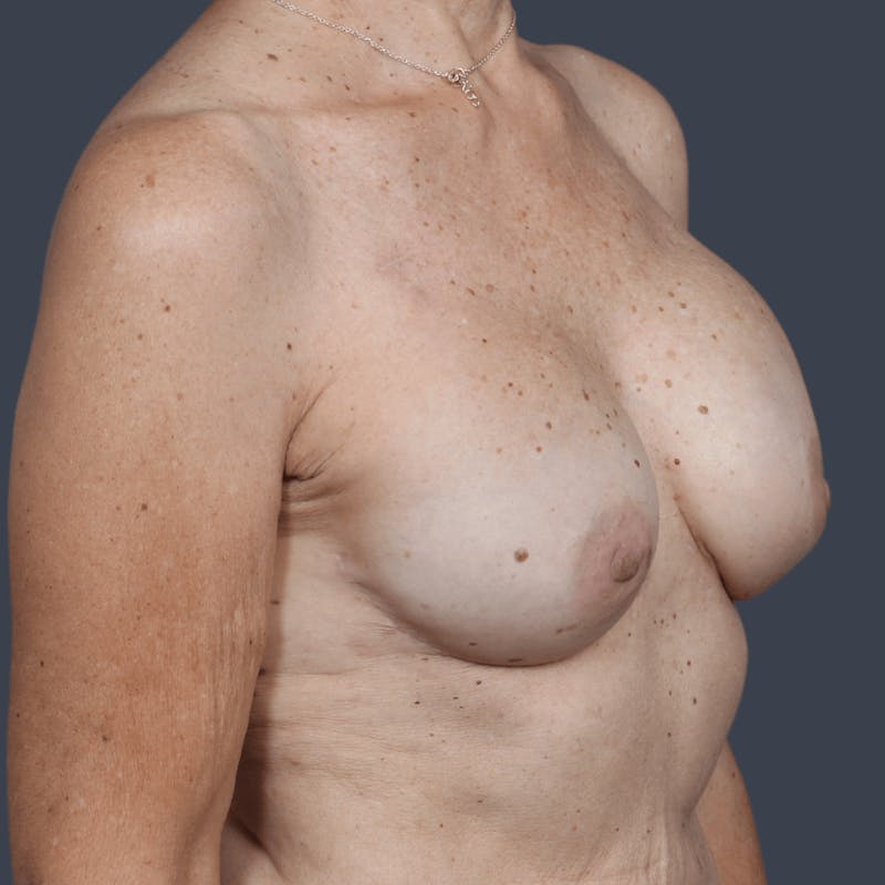 Breast Reconstruction Revision Before & After Gallery - Patient 312480 - Image 4