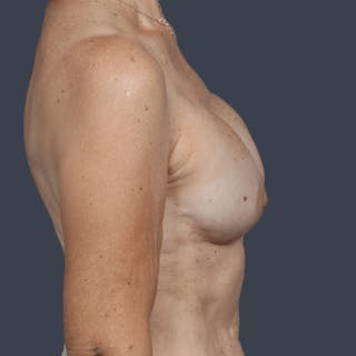 Breast Reconstruction Revision Before & After Gallery - Patient 312480 - Image 6