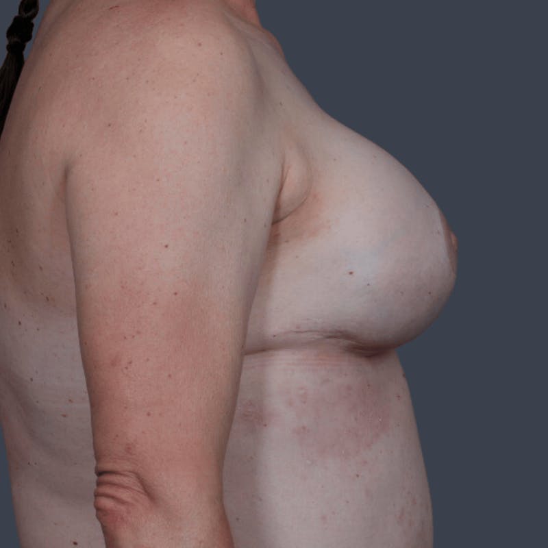 Breast Reconstruction Revision Before & After Gallery - Patient 360330 - Image 6